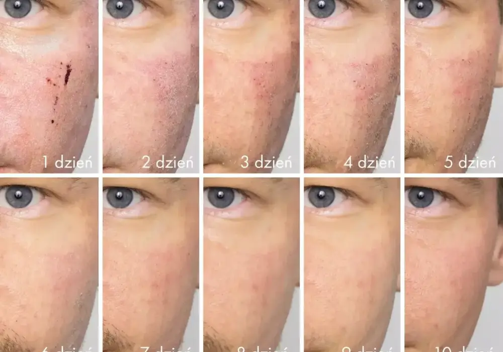 Strupki po depilacji laserowej - Kiedy to normalne, a kiedy problem?