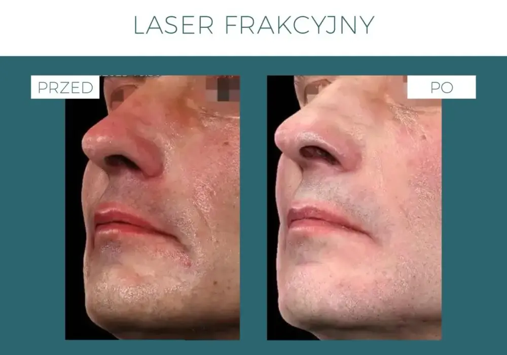 Laser frakcyjny - Skutki uboczne czy norma? Rozwiej wątpliwości!