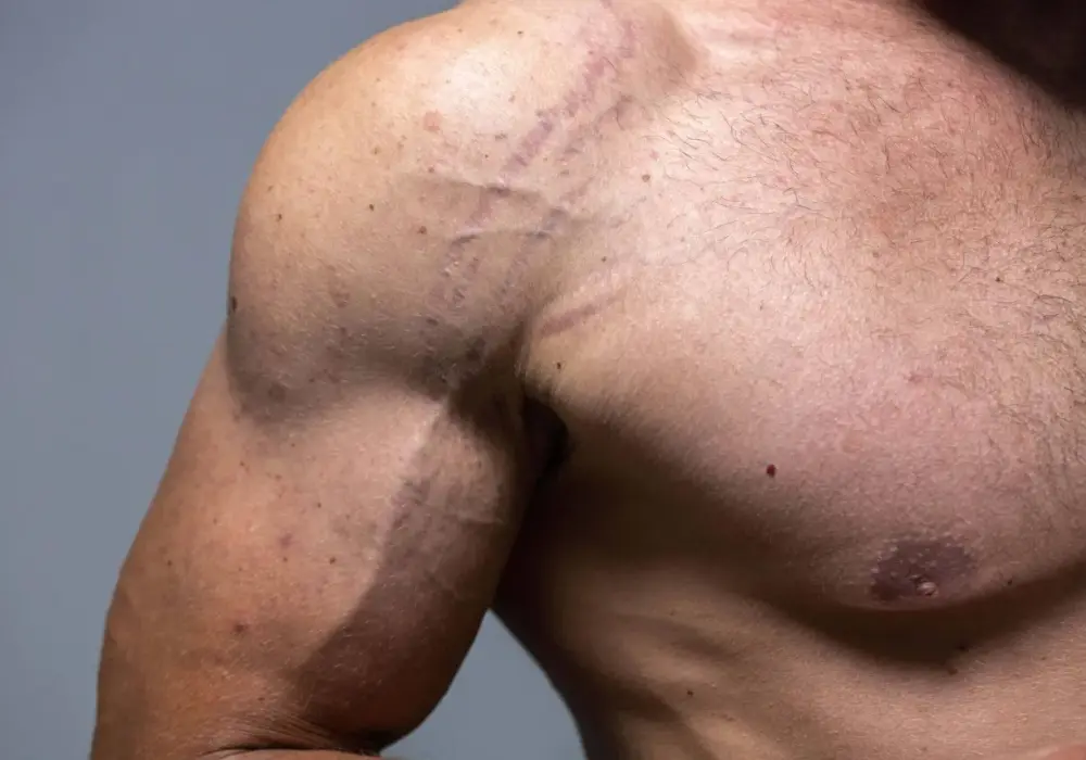 Rozstępy na bicepsie - Co działa, a co tylko obiecuje?