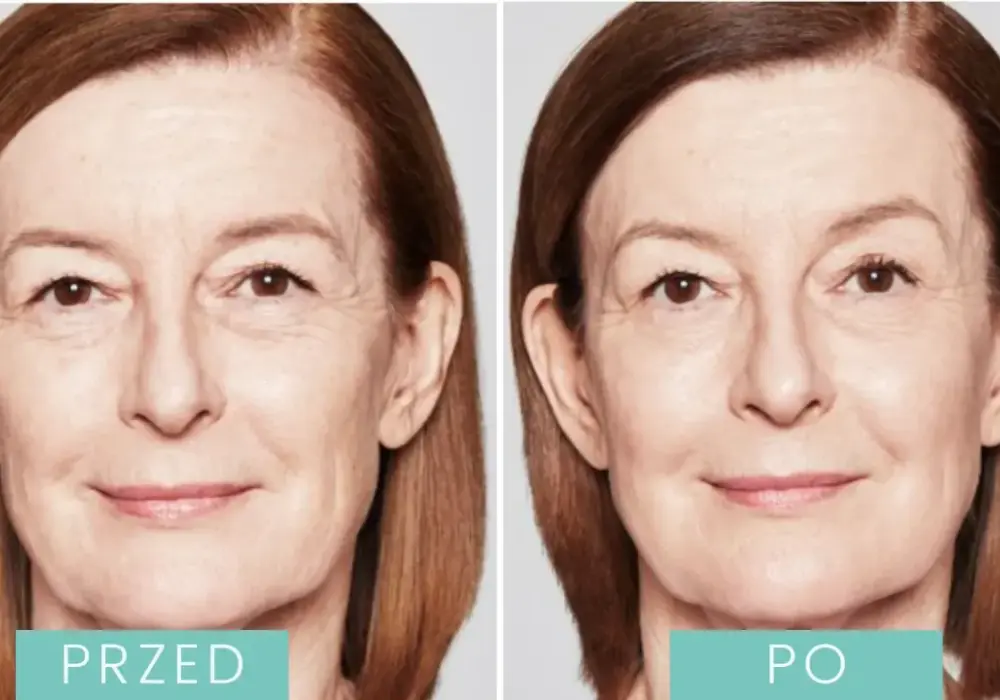 Sculptra - Jak działa biostymulator? Efekty, cena, opinie