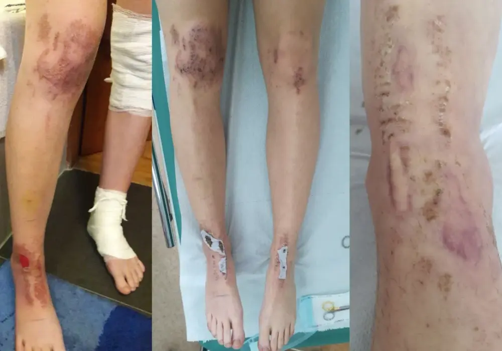 Oparzenia po depilacji laserowej - Co robić i kiedy do lekarza?