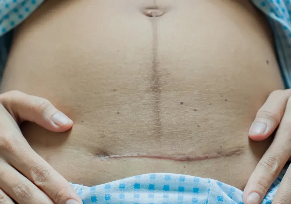 Kiedy można się golić po cesarce? Kluczowe informacje dla mam