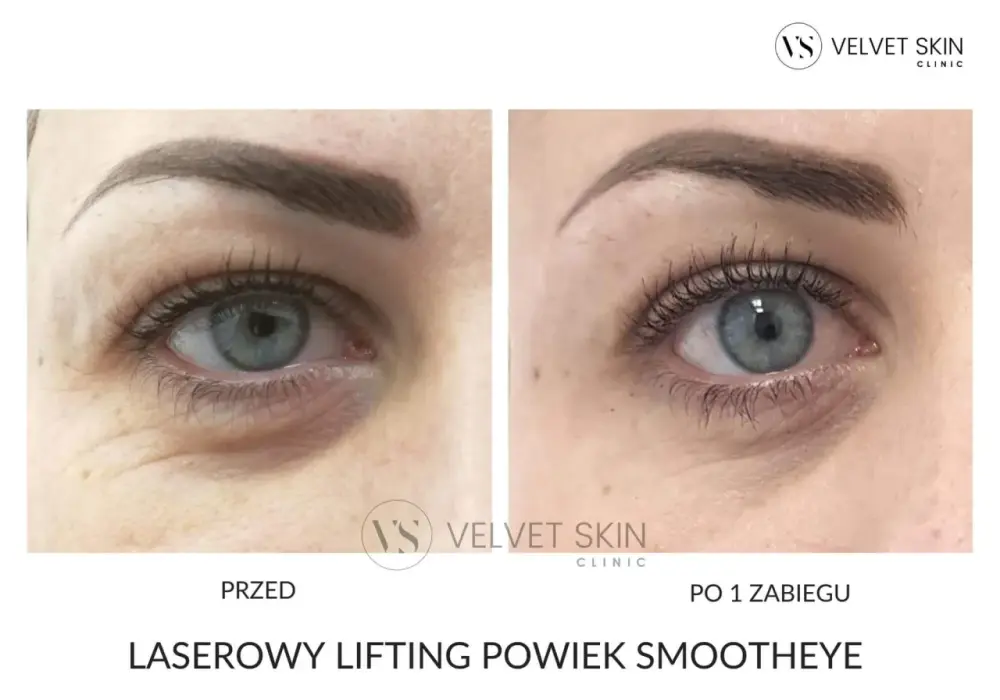Laser na powieki - Resurfacing czy plastyka? Wybierz mądrze!
