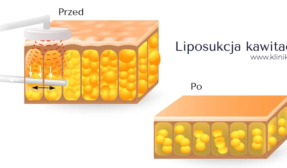 Liposukcja kawitacyjna - Czy to naprawdę działa? Sprawdź!