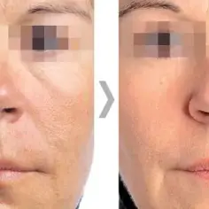 Endermologia twarzy ile zabiegów potrzebujesz, aby uzyskać efekty?