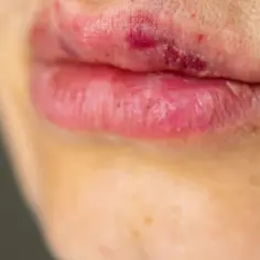 Usta z zaczerwienieniem i otarciami, mogą być efektem ubocznym endermologii.