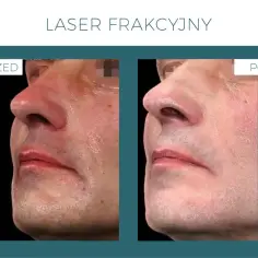 Przed i po zabiegu laserem frakcyjnym. Widoczne zmiany w teksturze skóry, redukcja zaczerwienień. Laser frakcyjny skutki uboczne są minimalne.