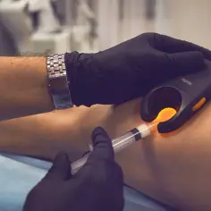 Lekarz w czarnej rękawiczce używa urządzenia do podświetlania żył podczas zabiegu skleroterapii. Poznaj skleroterapia cena.