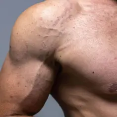 Widoczne rozstępy na bicepsie, ślady intensywnego treningu i rozwoju mięśni. Skóra z widocznymi bliznami.