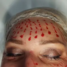 Czoło z licznymi czerwonymi kropkami po ostrzykiwaniu osoczem. Skóra przygotowana do zabiegu.