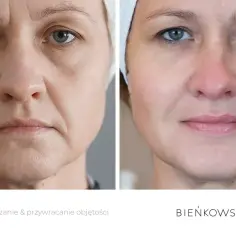 Przed i po lipotransferze: głębokie odmłodzenie i przywrócenie objętości twarzy.