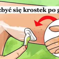 Jak pozbyć się krost po goleniu bikini - skuteczne metody i porady
