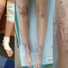 Oparzenia po depilacji laserowej na nogach i kostkach, z widocznymi ranami i opatrunkami.