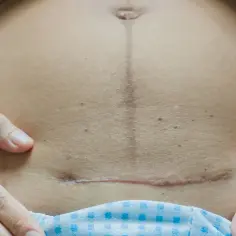Kiedy można się golić po cesarce? Kluczowe informacje dla mam