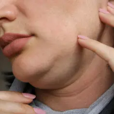 Kobieta dotyka palcami policzka i podbródka, ukazując jego pełny kształt.