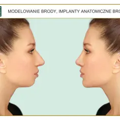 Przed i po modelowaniu brody. Zabieg poprawiający profil twarzy.