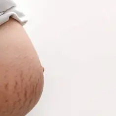Czerwone rozstępy na brzuchu kobiety, świadectwo pięknej podróży macierzyństwa.