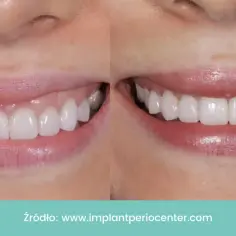 Uśmiech przed i po zabiegu. Zredukowany gummy smile dzięki botoksowi. Piękne, białe zęby.