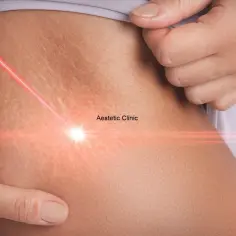 Laserowe leczenie rozstępów w Aestetic Clinic. Skóra z widocznymi rozstępami, na którą skierowany jest czerwony promień lasera.