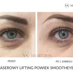 Przed i po zabiegu laserowy lifting powiek. Skóra wokół oczu wygładzona, zmarszczki zredukowane.