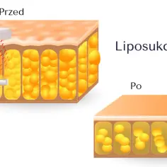 Przed i po zabiegu liposukcja kawitacyjna. Ilustracja pokazuje redukcję komórek tłuszczowych.