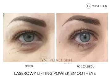 Przed i po zabiegu laserowy lifting powiek. Skóra wokół oczu wygładzona, zmarszczki zredukowane.