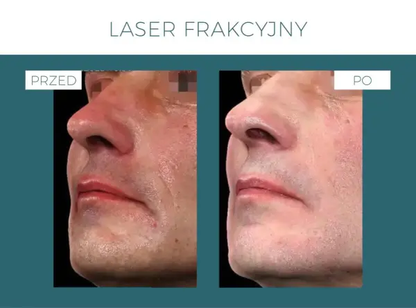 Laser frakcyjny - Skutki uboczne czy norma? Rozwiej wątpliwości!