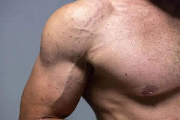 Rozstępy na bicepsie - Co działa, a co tylko obiecuje?
