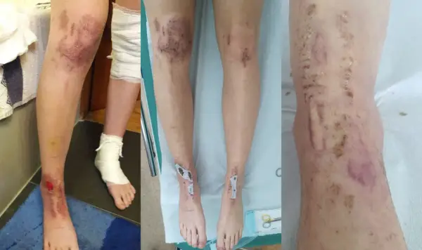 Oparzenia po depilacji laserowej - Co robić i kiedy do lekarza?