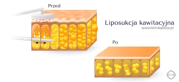 Liposukcja kawitacyjna - Czy to naprawdę działa? Sprawdź!